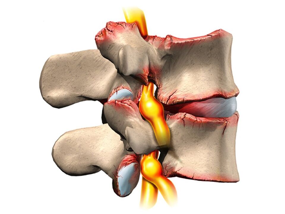 spinal samad uban sa osteochondrosis