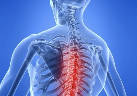 osteochondrosis sa thoracic spine