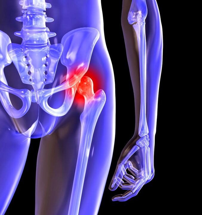 Pag-usab sa Arthrosis sa Hip Joint