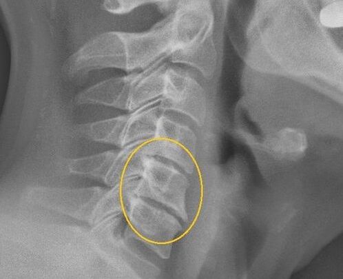 Osteochondrosisis sa cervical spine sa usa ka X -ray