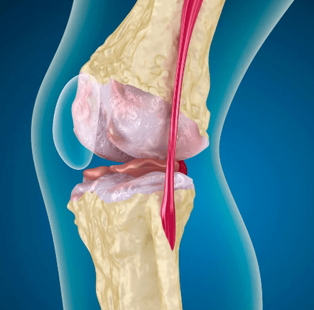 Arthrosisis sa lutahan sa tuhod