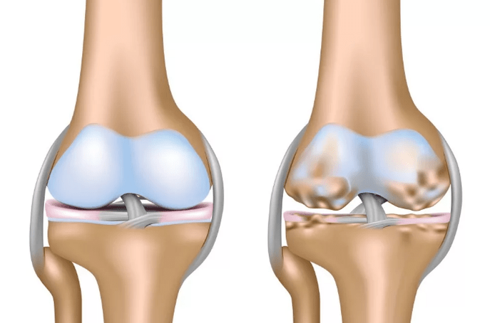 Pag-usab sa arthrosis sa tuhod nga hiniusa