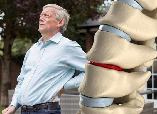 Ang Osteochondrosis nakaapekto sa mga intervertebral disc ug hinungdan sa sakit sa likod