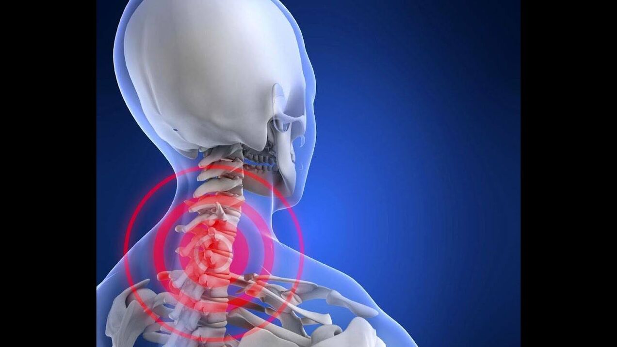 Osteochondrosis sa cervical spine